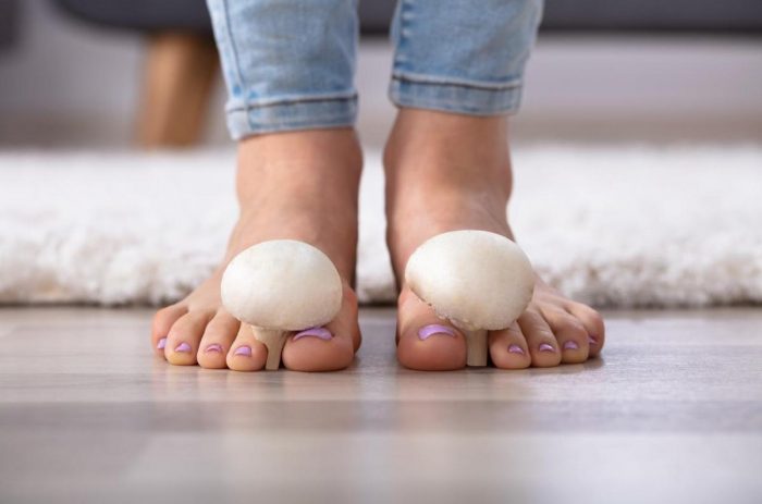 Comment traiter rapidement les mycoses des pieds ?